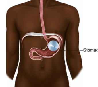 Ibyo wamenya kuri Gastric Balloon ifasha abantu gutakaza 15% y’ibilo byabo mu mezi atandatu