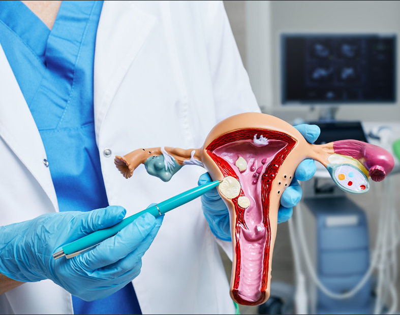 Menya byinshi ku ndwara ya Fibroids izahaza abagore ndetse ikaba yibasira abafite umubyibuho ukabije kandi ikaba ishobora gutera ubugumba uyirwaye