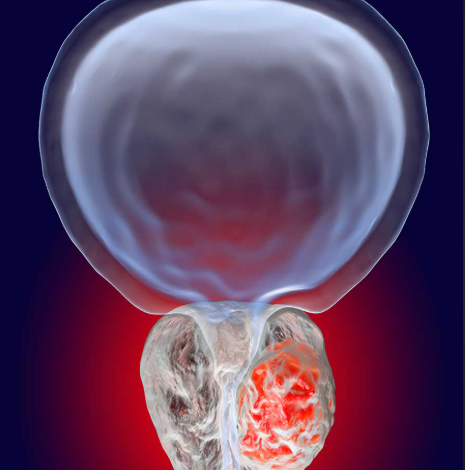 Vitamin D ishobora kwifashishwa mu guhashya kanseri ya prostate: Ubushakashatsi