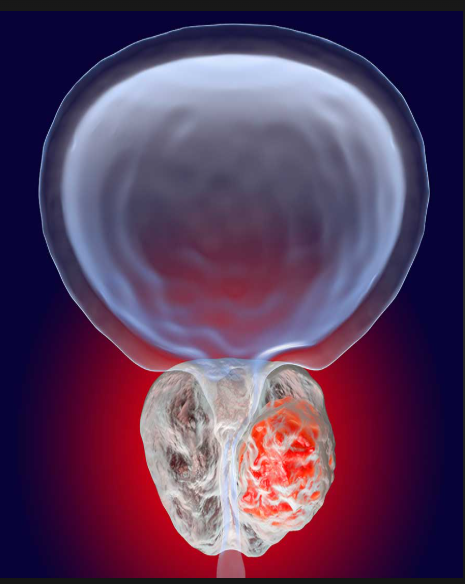 Vitamin D ishobora kwifashishwa mu guhashya kanseri ya prostate: Ubushakashatsi